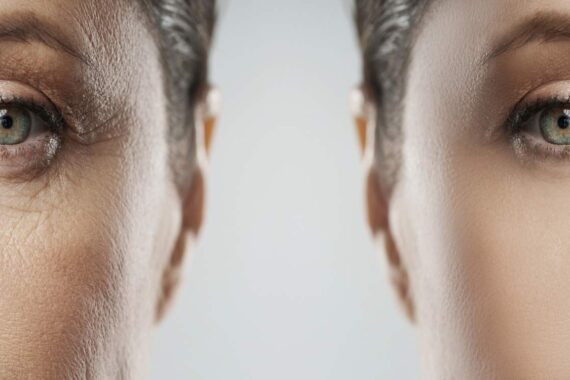 Laser frakcyjny – innowacyjny zabieg