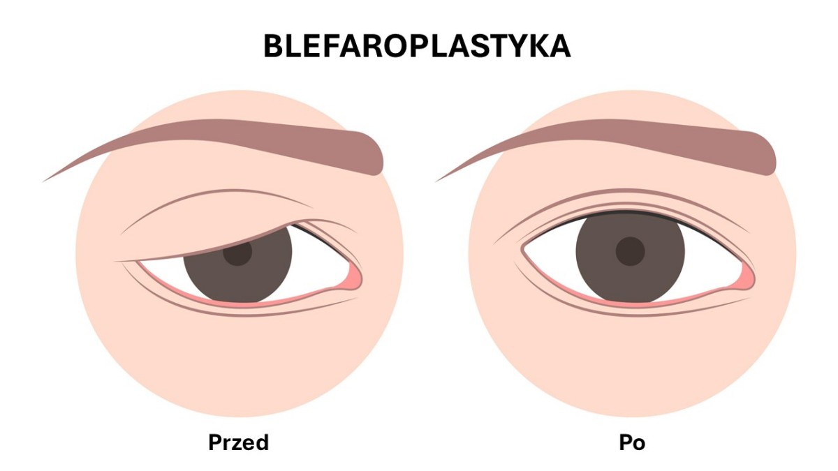 Blefaroplastyka &ndash; plastyka powiek g&oacute;rnych i dolnych