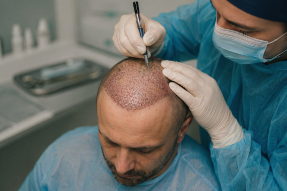 Procedura przeszczepu włos&oacute;w w trakcie